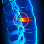 Low Back Pain